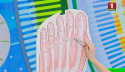 Вальгусная деформация - косточка на стопе Вальгусная деформация - косточка на стопе