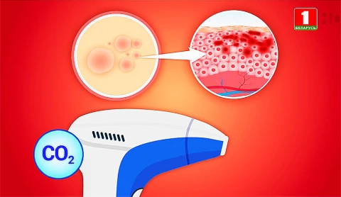 Склероатрофический лихен - в программе "Здоровье" Склероатрофический лихен - в программе "Здоровье"