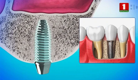 Технологии имплантации зубов, высокое давление у мужчин, водно-солевой баланс организма - в программе Здоровье Технологии имплантации зубов, высокое давление у мужчин, водно-солевой баланс организма - в программе Здоровье