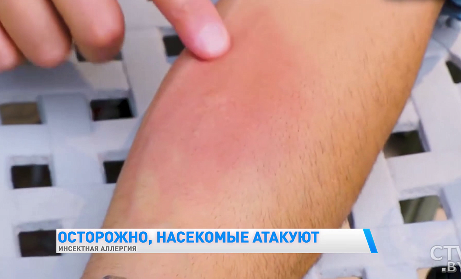 Аллергия на укусы насекомых: какие симптомы и что делать (+видео)