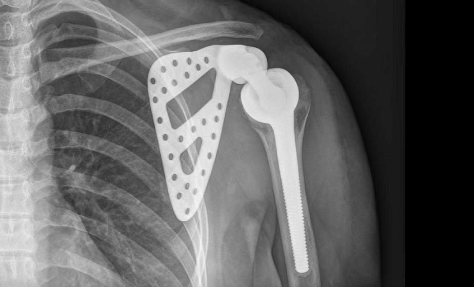 Белорусские ученые разработали высокотехнологичные имплантаты из титана